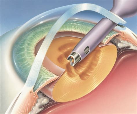 Cataract Surgery Valdosta